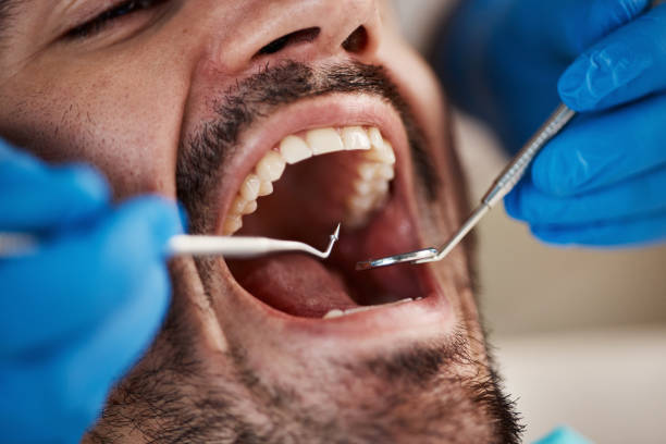 Best Chipped Tooth Repair Near Me  in Bessemer City, NC